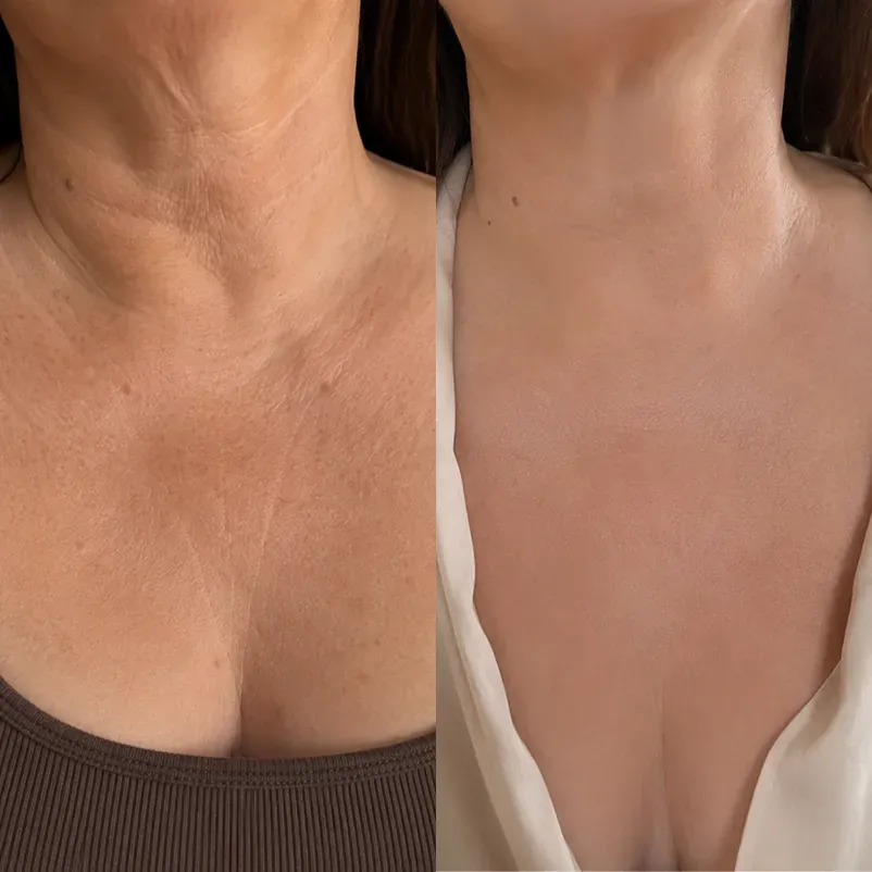 The Korean Needle-Free Toxin for Visibly Firmer, Smoother, And More Radiant Skin — Anywhere It Ages