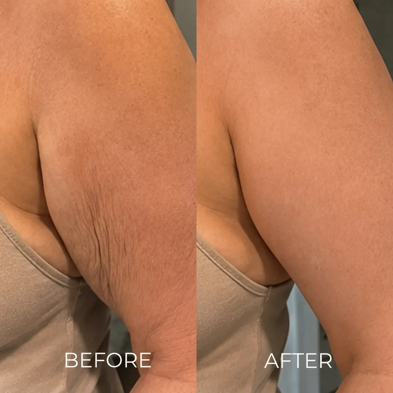 The Korean Needle-Free Toxin for Visibly Firmer, Smoother, And More Radiant Skin — Anywhere It Ages