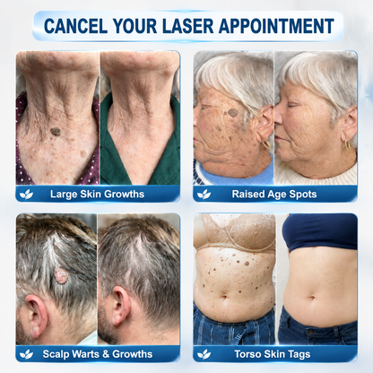 TopSpire® 👩‍⚕️7-Day 𝗦𝐤𝐢𝐧 𝐓𝐚𝐠 & 𝗪𝐚𝐫𝐭 𝐂𝐚𝐫𝐞 𝐏𝐫𝐞𝐜𝐢𝐬𝐢𝐨𝐧 𝐒𝐰𝐚𝐛𝐬（Individually Sealed, Single-Use）🔥 Visible Results in 7 Days—or Your Money Back! ✅💙