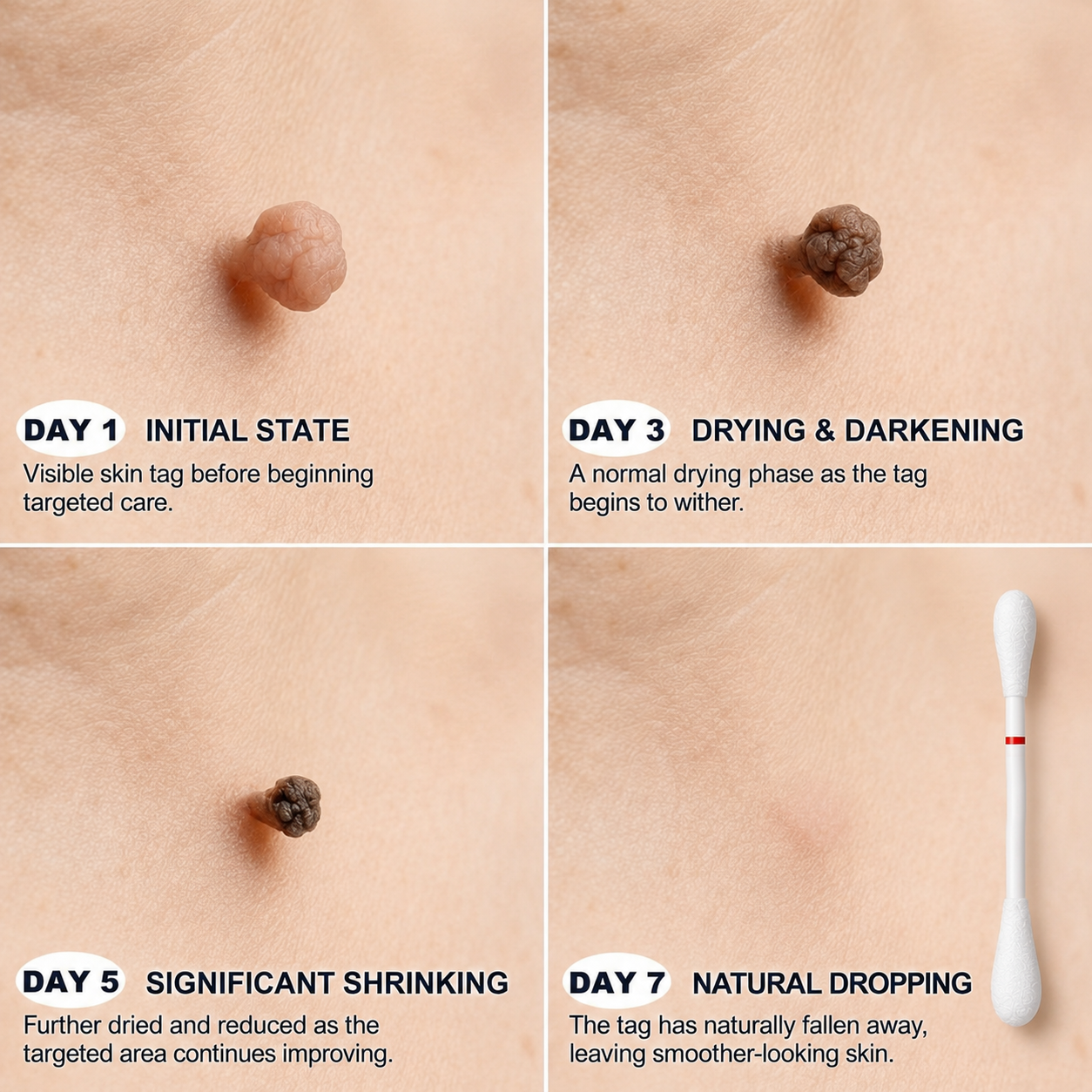 TopSpire® 👩‍⚕️7-Day 𝗦𝐤𝐢𝐧 𝐓𝐚𝐠 & 𝗪𝐚𝐫𝐭 𝐂𝐚𝐫𝐞 𝐏𝐫𝐞𝐜𝐢𝐬𝐢𝐨𝐧 𝐒𝐰𝐚𝐛𝐬（Individually Sealed, Single-Use）🔥 Visible Results in 7 Days—or Your Money Back! ✅💙