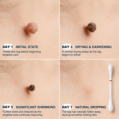 TopSpire® 👩‍⚕️7-Day 𝗦𝐤𝐢𝐧 𝐓𝐚𝐠 & 𝗪𝐚𝐫𝐭 𝐂𝐚𝐫𝐞 𝐏𝐫𝐞𝐜𝐢𝐬𝐢𝐨𝐧 𝐒𝐰𝐚𝐛𝐬（Individually Sealed, Single-Use）🔥 Visible Results in 7 Days—or Your Money Back! ✅💙